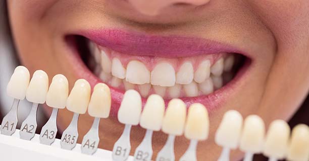 Tooth-Colored Fillings
